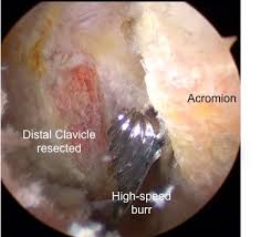 מפרק עצם הבריח בכתף ACJ