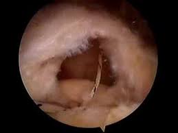 תפירת השרוול המסובב - RC