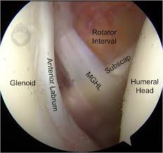 ארטרוסקופיה של הכתף