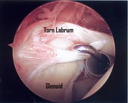 ניתוח לברום תחתון BANKART