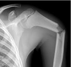 שבר בראש הזרוע